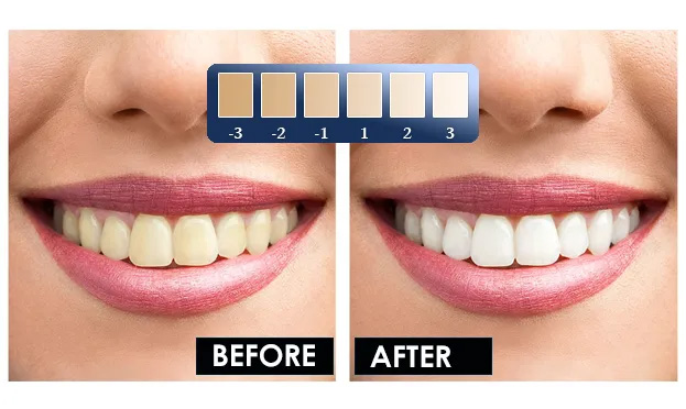 Bella Teeth Whitening results