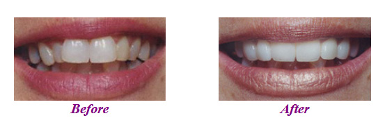 before after Porcelain Veneers