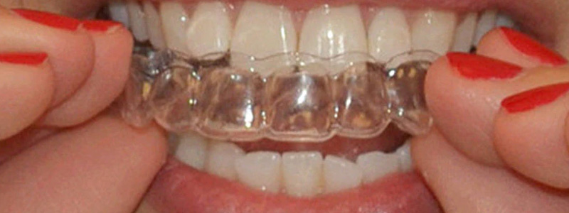 best Teeth Whitening Trays