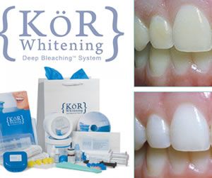 https://www.theteethwhiteningcenter.com/wp-content/uploads/2020/02/korwhitening.jpg