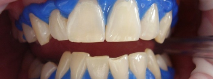 teeth bleaching