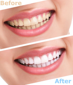 teeth whiteners before after