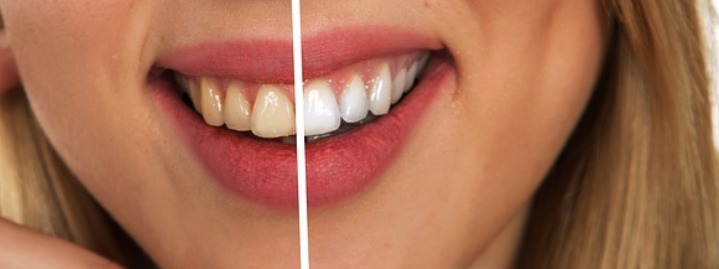 The Importance of Having White Teeth